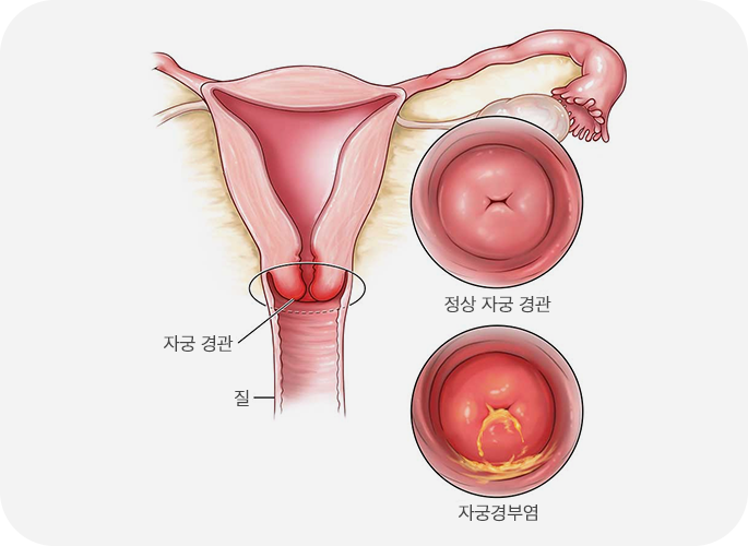 질염 및 자궁경부염을 통한 감염
