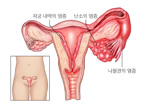 골반염