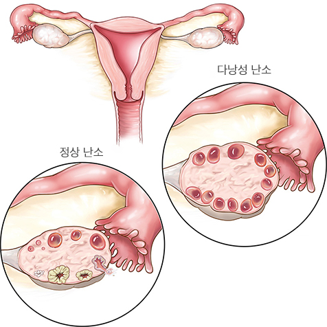다낭난소증후군