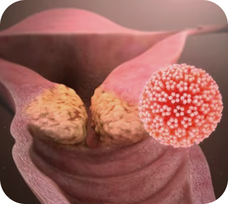 인유두종 바이러스(HPV)