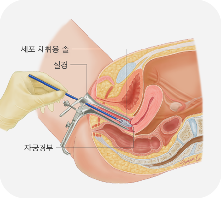 자궁경부암 검사