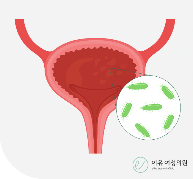 방광염