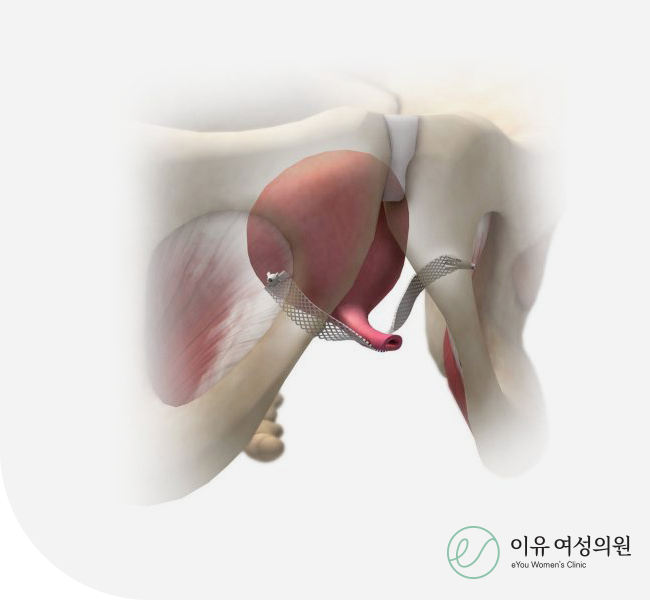 복압성 요실금