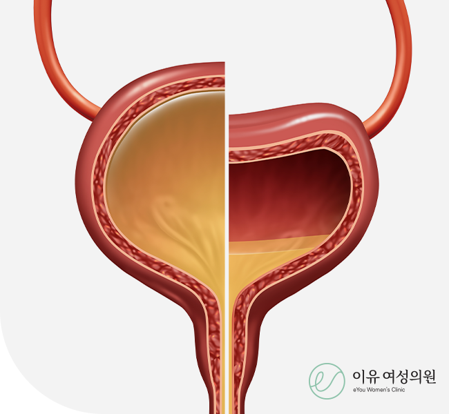 과민성 방광